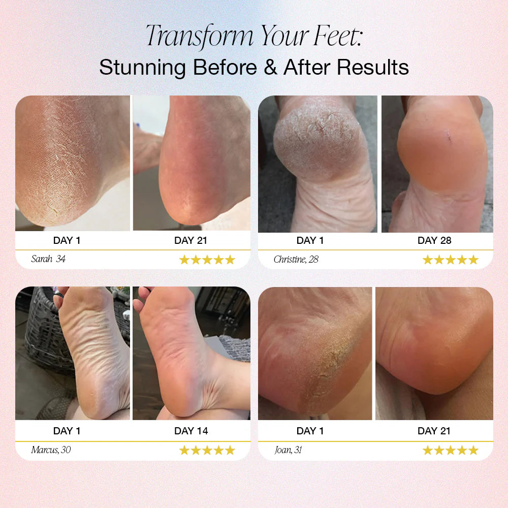 DermaZen™ Electric Foot Callus Remover