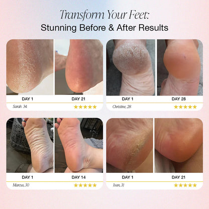 DermaZen™ Electric Foot Callus Remover
